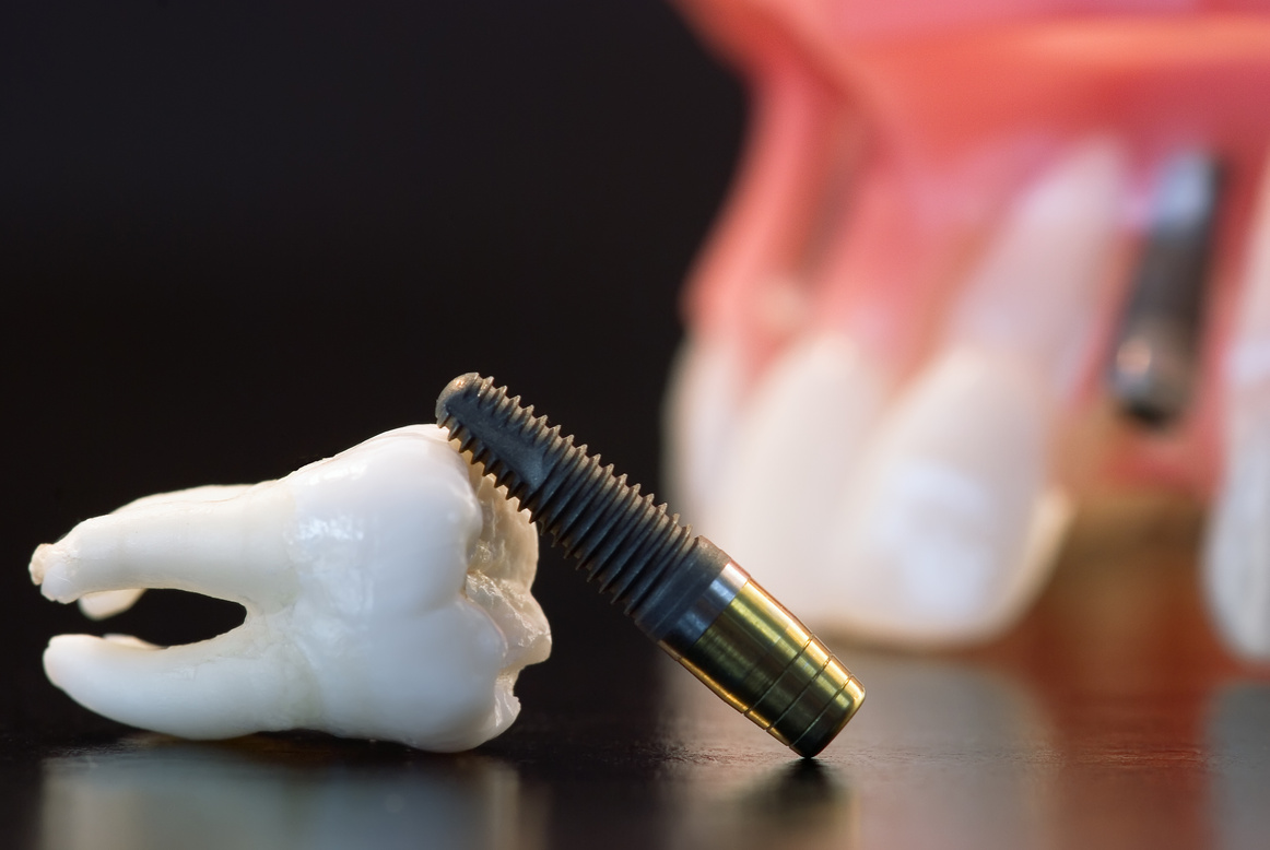 Wisdom tooth, Dental Implant and Plastic model